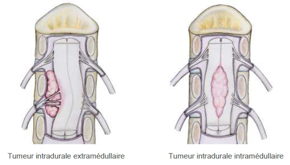 Tumeur intradurale